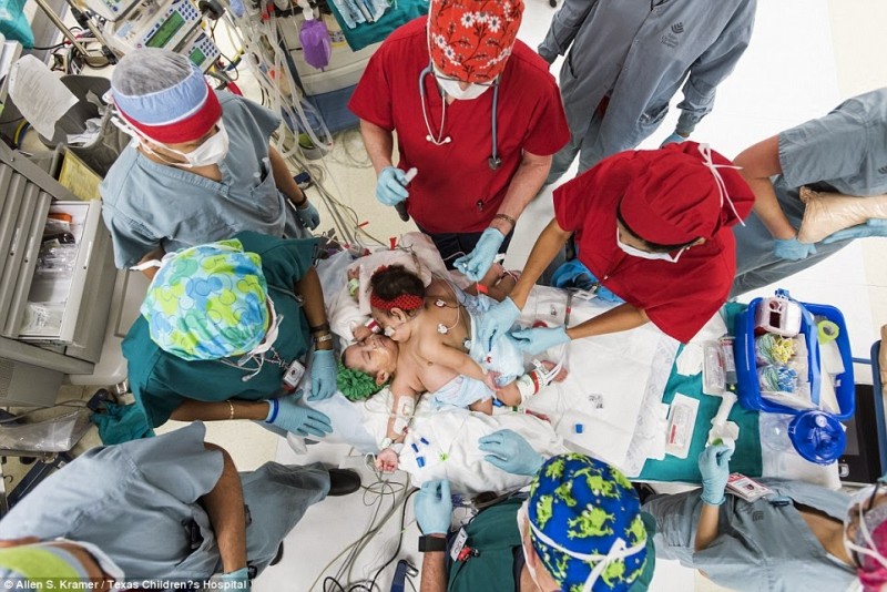 Conjoined twins successfully separated for the first time in history (See Photos) theinfong.com