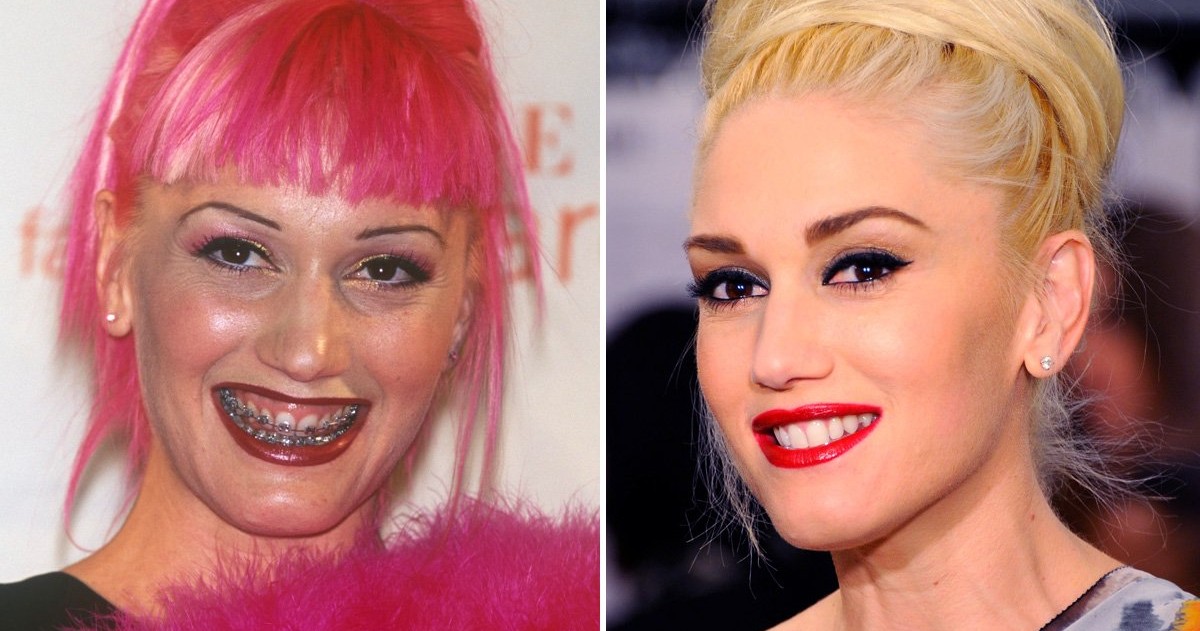 20 Celebrities You Won’t Believe Had Braces  theinfong.com