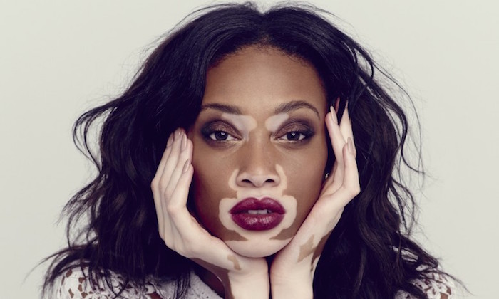 Winnie-Harlow-15 hottest models who live with chronic diseases and disabilities (With Pictures)- theinfong.com jpeg-700x420