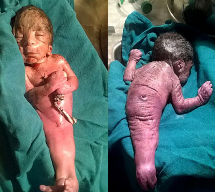 Photos: baby born with deadly condition where legs fuse together in the womb theinfong.com 700x623