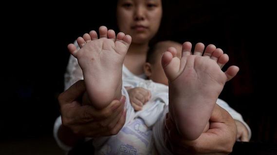 Chinese baby born with 15 fingers and 16 toes...(photos) theinfong.com