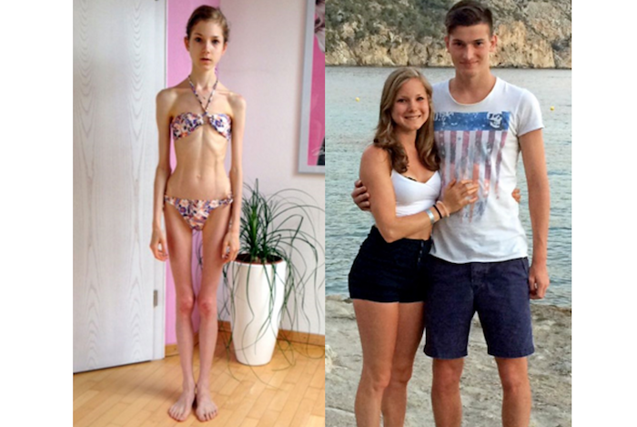 Girl battling anorexia who weighed just three and half stone says love saved her life (Amazing Pics) theinfong.com 700x469