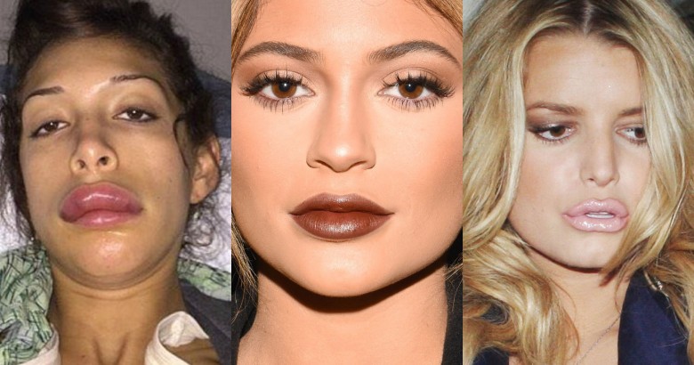 Celebs who have done their lips after Kylie Jenner did