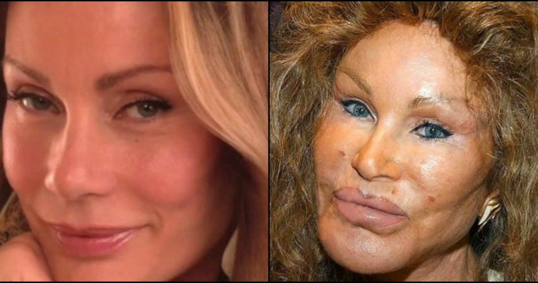 celebs who ruined their own looks with plastic surgeries
