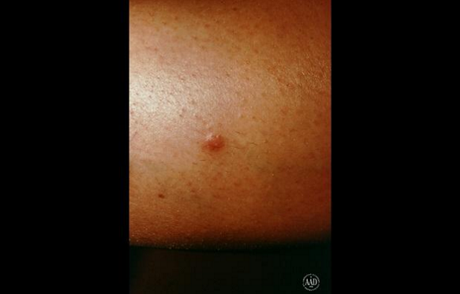 skin-spots-you-should-never-ignore