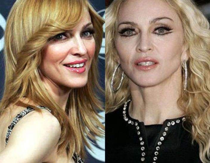 Celebrities Who Ruined Their Lives With Plastic Surgery Wanted To Look Like A Barbie But