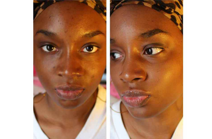 How To Get Rid Of Black Spots On Your Face In Just 15 Minutes Theinfong