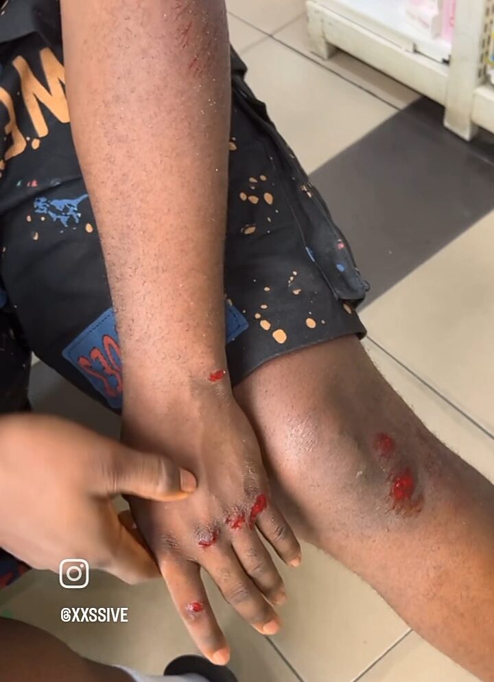 “The Keke somersaulted 3-4 times, yet I came out alive” – Nkechi Blessing’s boyfriend shares testimony as he survives ghastly accident (Video)