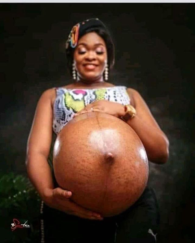 woman with abnormal baby bump 2