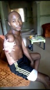 The man should sue them -Nigerians blast UBA for reportedly donating 'just' N1m to painter who lost his arm while working for them