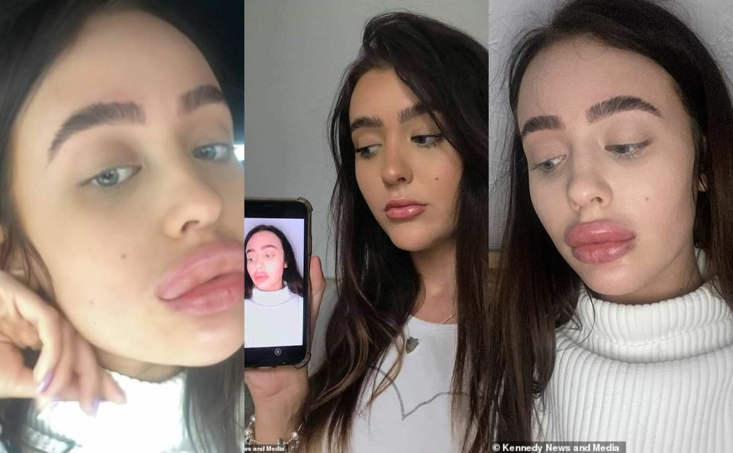 Lady's lips triple in size after botched lip filler treatment (photos)