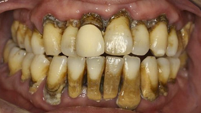 15 Disgusting People Who Need To See A Dentist Immediately Their Teeth Will Make You Cringe